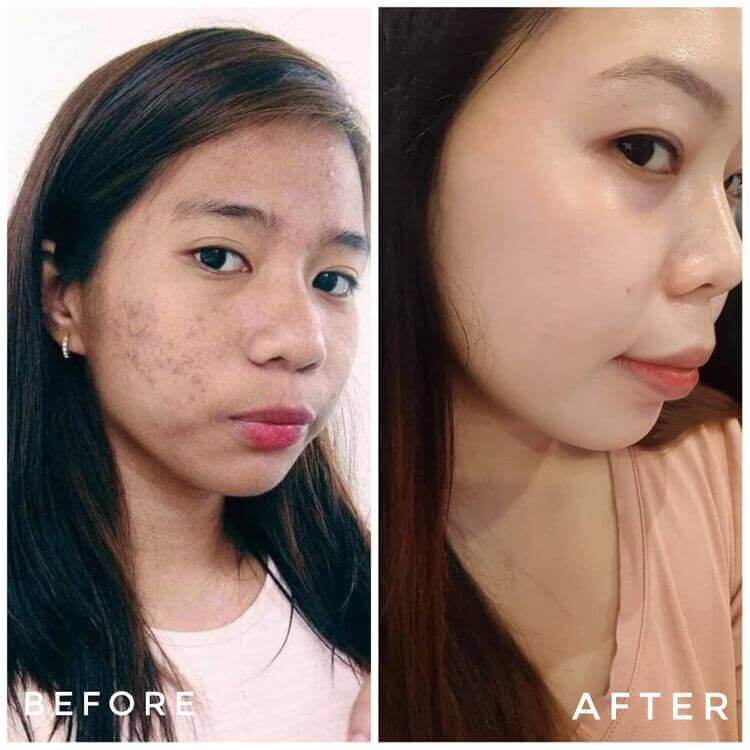 Trước sau Lumos acne
